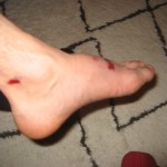 Foot Injury